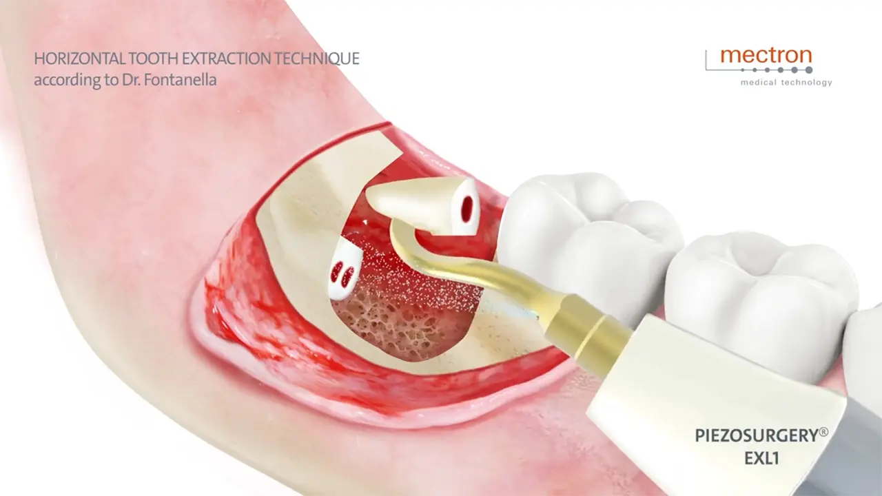 PIEZOSURGERY - Dr. Fabrizio Fontanella - Horizontal tooth extraction technique