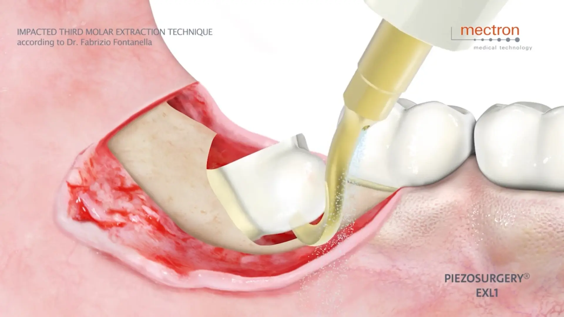 PIEZOSURGERY - Dr. Fabrizio Fontanella - Impacted third molar extraction technique