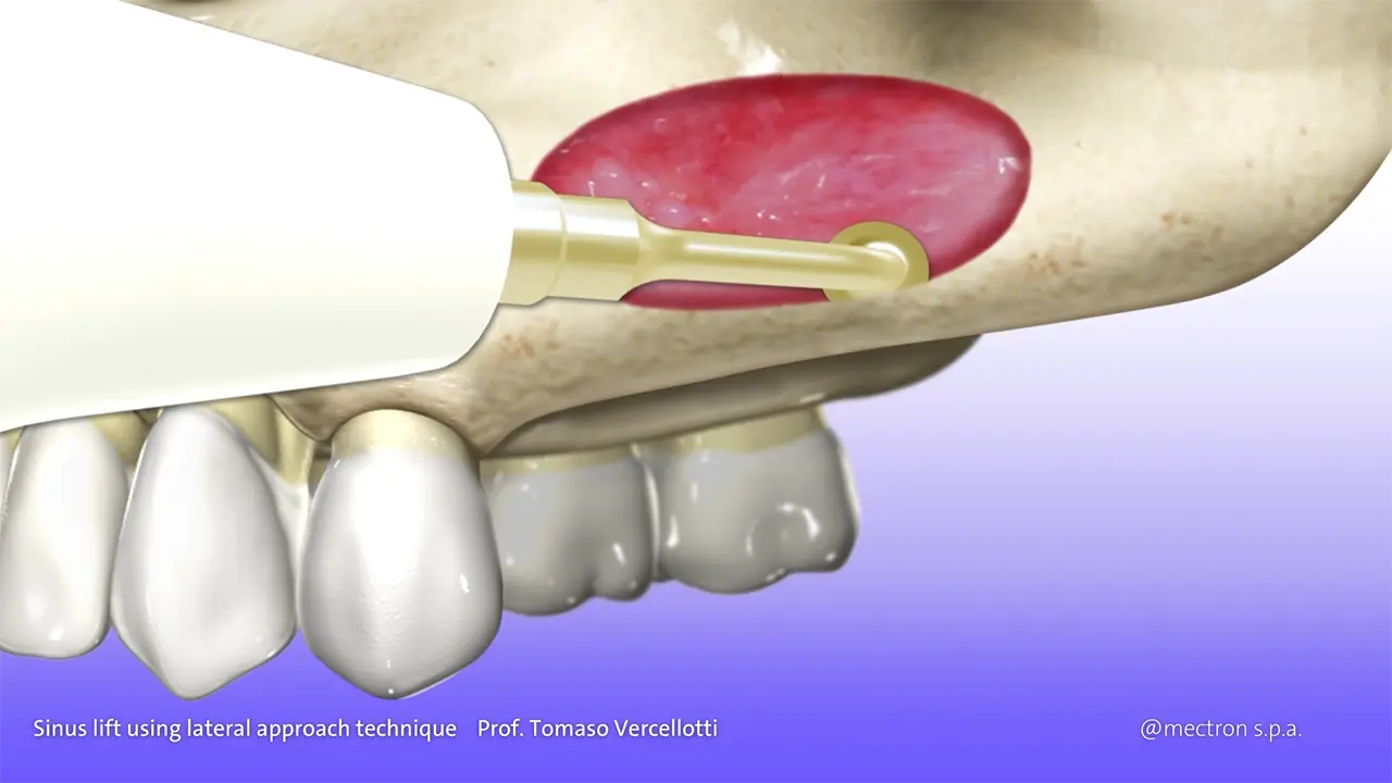 PIEZOSURGERY - Prof. Tomaso Vercellotti - Sinus lift using lateral approach technique by
