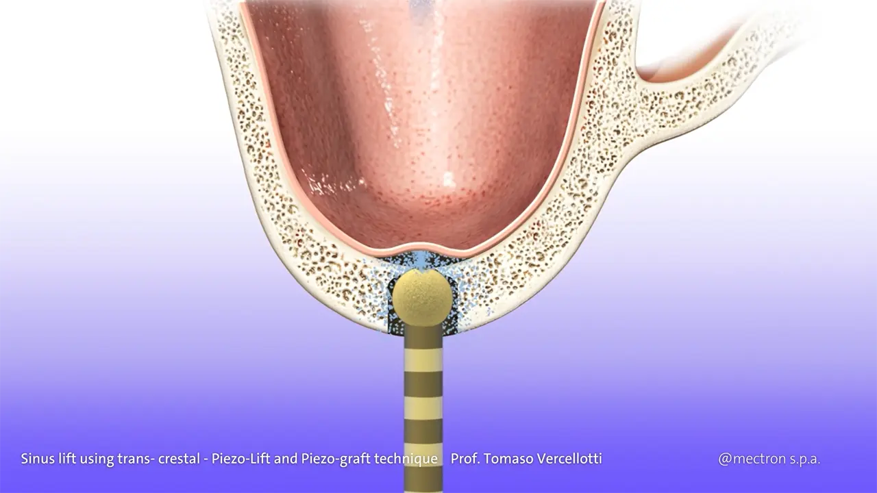 PIEZOSURGERY - Prof. Tomaso Vercellotti - Sinus lift using trans- crestal approach - Piezo-Lift and Piezo-graft technique