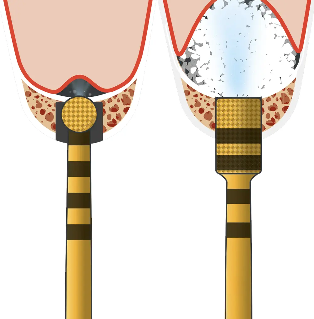 Sinus piezo-lift technique